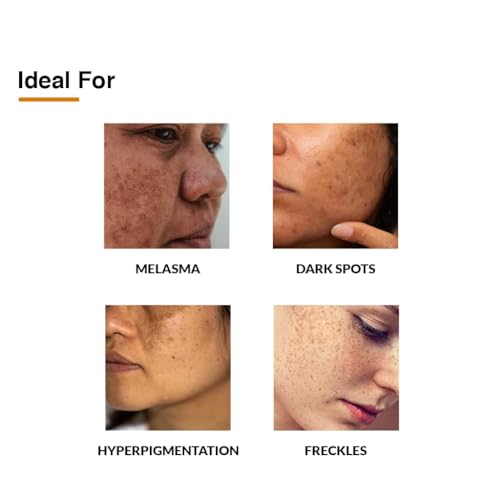 Fixderma 2% Kojic Acid + 1% Arbutin Skarfix-Plus Scar Removal Cream | Hyperpigmentation Removal Cream and Acne Scars Removal Cream | Helps to Reduce Melasma- 15 g