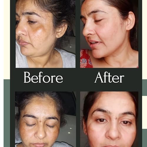 Shiv Aatman Dark Spots Removal Face cream for men and women. Super Effective in Removal of pigmentation, melasma, dark spots, uneven patchy dark skin, tanning, acne scars. (30 Gram, 2, count)