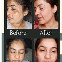 Shiv Aatman Dark Spots Removal Face cream for men and women. Super Effective in Removal of pigmentation, melasma, dark spots, uneven patchy dark skin, tanning, acne scars. (30 Gram, 2, count)