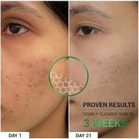 Sereko Pore Clearing Face Wash with 1% Salicylic Acid & Lactic Acid | Foaming Cleanser for Oily & Acne-Prone Skin | Deep Cleansing & Gentle Exfoliation | Sulfate-Free | For Men & Women | 100ml