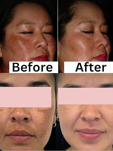 Shiv Aatman Dark Spots Removal Face cream for men and women. Super Effective in Removal of pigmentation, melasma, dark spots, uneven patchy dark skin, tanning, acne scars. (30 Gram, 2, count)