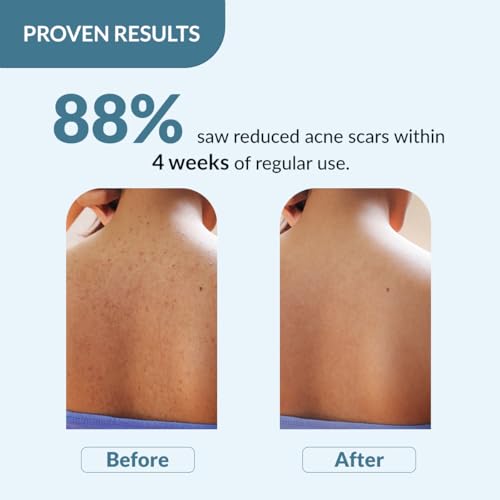 Fixderma Salyzap 2% Salicylic Acid Body Wash For Acne, Clean Pores Suitable For Acne Prone Skin - 100ml