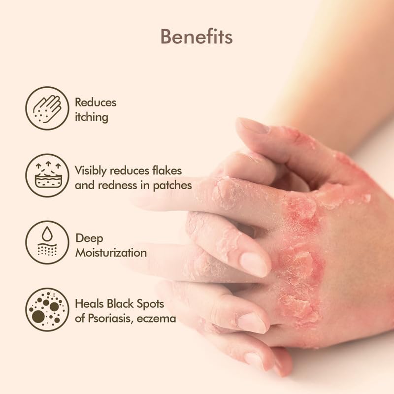 VEDICDERM Oleander Psoriasis Skin Care Oil Natural, Steroid-Free Formula for Dry, Itchy, and Flaky Skin Helps Soothe Irritation, Redness, & Promote Hydration, Suitable for Daily Use (200ml Pack of 1)