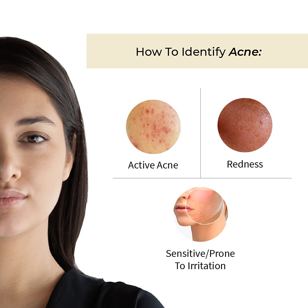 Vedix Face Serum, Customised Ayurvedic Prakhya Acne Rescue Face Serum for Acne Prone Skin With Aloe Vera + Vacha + Bakuchi - 20 ml