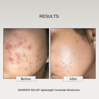 The Formularx Barrier Relief Ceramide Lightweight Moisturizer With Niacinamide & Hyaluronic Acid | For Oily, Combination, Dehydrated, Acne Prone, Sensitive Skin | 50 Gram