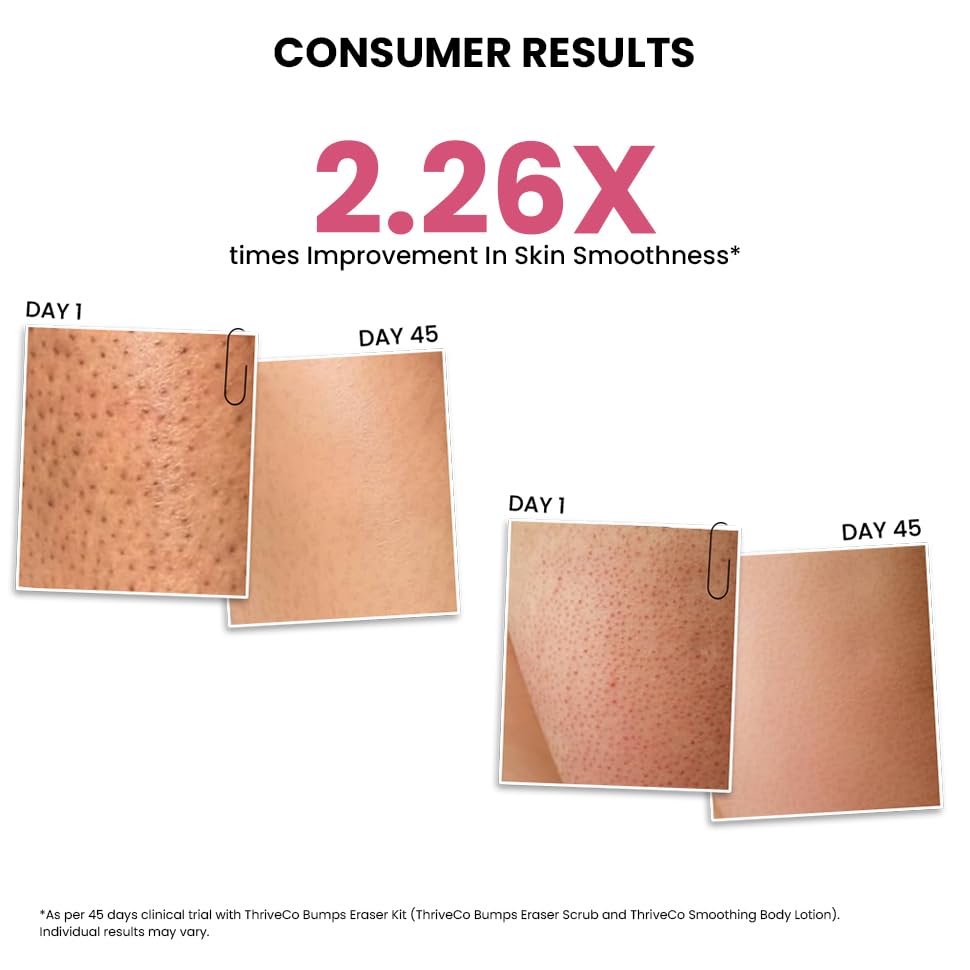 ThriveCo Smoothing Body Lotion for Dry, Rough & Bumpy skin | With AHA, Mahua Oil & Urea | Moisturizes, Hydrates & Treats Keratosis Pilaris,Strawberry Skin in Men & Women | 150 ml