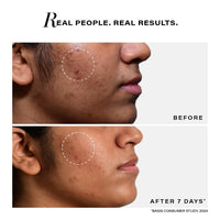 Novology Acne Clearing Serum with Thymol and Terpineol | Face Serum For Acne, Whiteheads, Blackheads | Non-sticky, Non-Irritating, Non-Comedogenic| For Oily, Acne Prone Skin | 28 ML