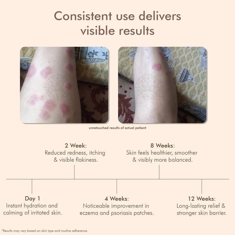 VEDICDERM Oleander Psoriasis Skin Care Oil Natural, Steroid-Free Formula for Dry, Itchy, and Flaky Skin Helps Soothe Irritation, Redness, & Promote Hydration, Suitable for Daily Use (200ml Pack of 1)