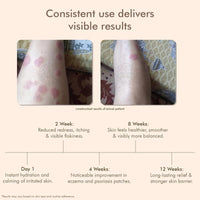 VEDICDERM Oleander Psoriasis Skin Care Oil Natural, Steroid-Free Formula for Dry, Itchy, and Flaky Skin Helps Soothe Irritation, Redness, & Promote Hydration, Suitable for Daily Use (200ml Pack of 1)