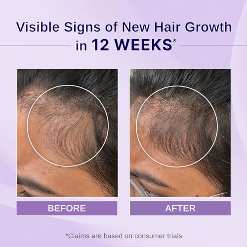 Bare Anatomy Nature x Science Rosemary Hibiscus Hair Growth Oil for Women & Men | Promotes New Hair Growth & Strengthens Hair | Nourishes Scalp & Controls Hair Fall | Suitable for All Hair Types-100ml