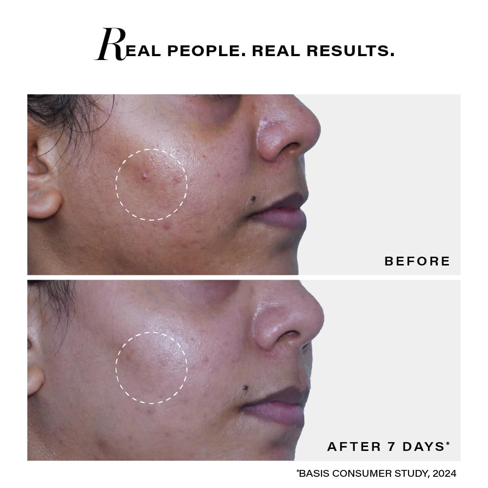 Novology Acne Deep Clearing Cleanser with Thymol+Terpineol| Face Wash for Acne,Whiteheads,Blackheads| Gentle, Non-Drying Formula, Suitable for Sensitive skin| 150ml