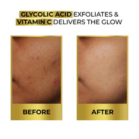 Streax Bright & Shine Face Serum, 30 ml|10% Vitamin C Serum|Brighter Skin in 3 Days|Serum for Glowing Skin| Reduces Dark Spots & Pigmentation|Niacinamide serum, Vitamin C Face Serum for Women & Men