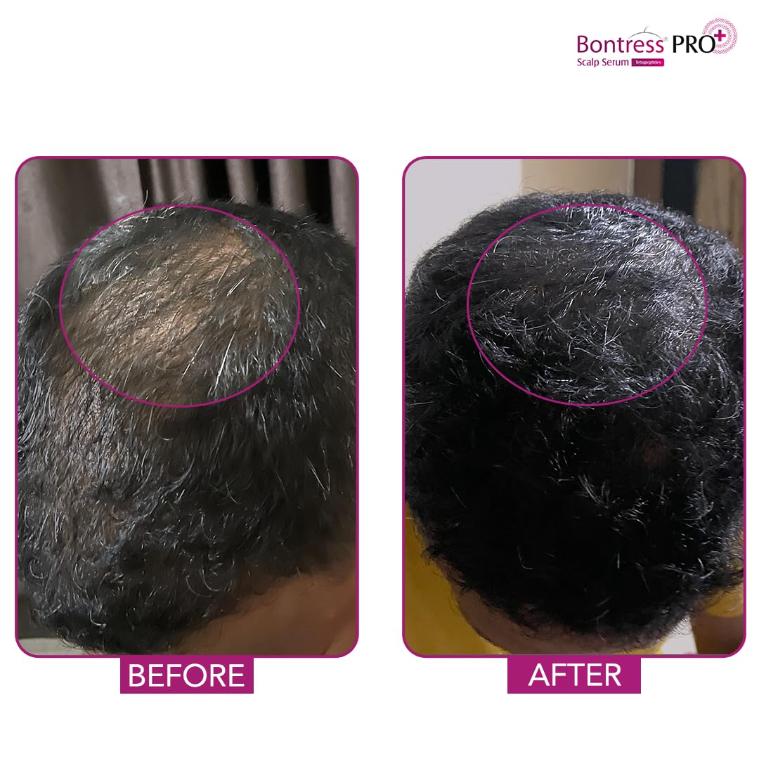 Bontress PRO+ Scalp Serum Fortified with Redensyl, Anagain, Capixyl,Procapil | Hair Serum for Hair Growth & Hair Fall 30ml