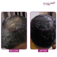 Bontress PRO+ Scalp Serum Fortified with Redensyl, Anagain, Capixyl,Procapil | Hair Serum for Hair Growth & Hair Fall 60ml