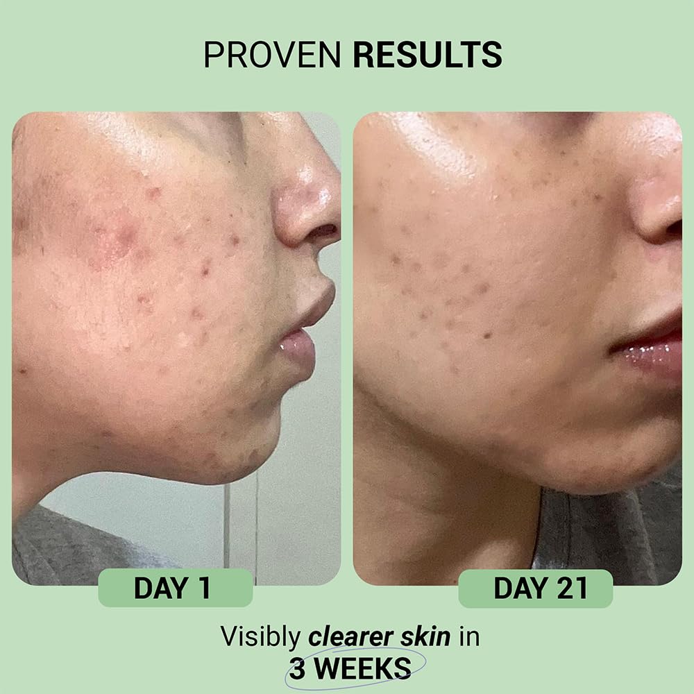 Sereko Skin Clearing Syrup | Sea Buckthorn,Manjishtha,Shatavri & Berberine + 12 Purifying Actives | Blood Purifier,Acne & Pimple Control | Enhances Skin Glow | Mixed Berry Flavour- 200 ML Pack of 1