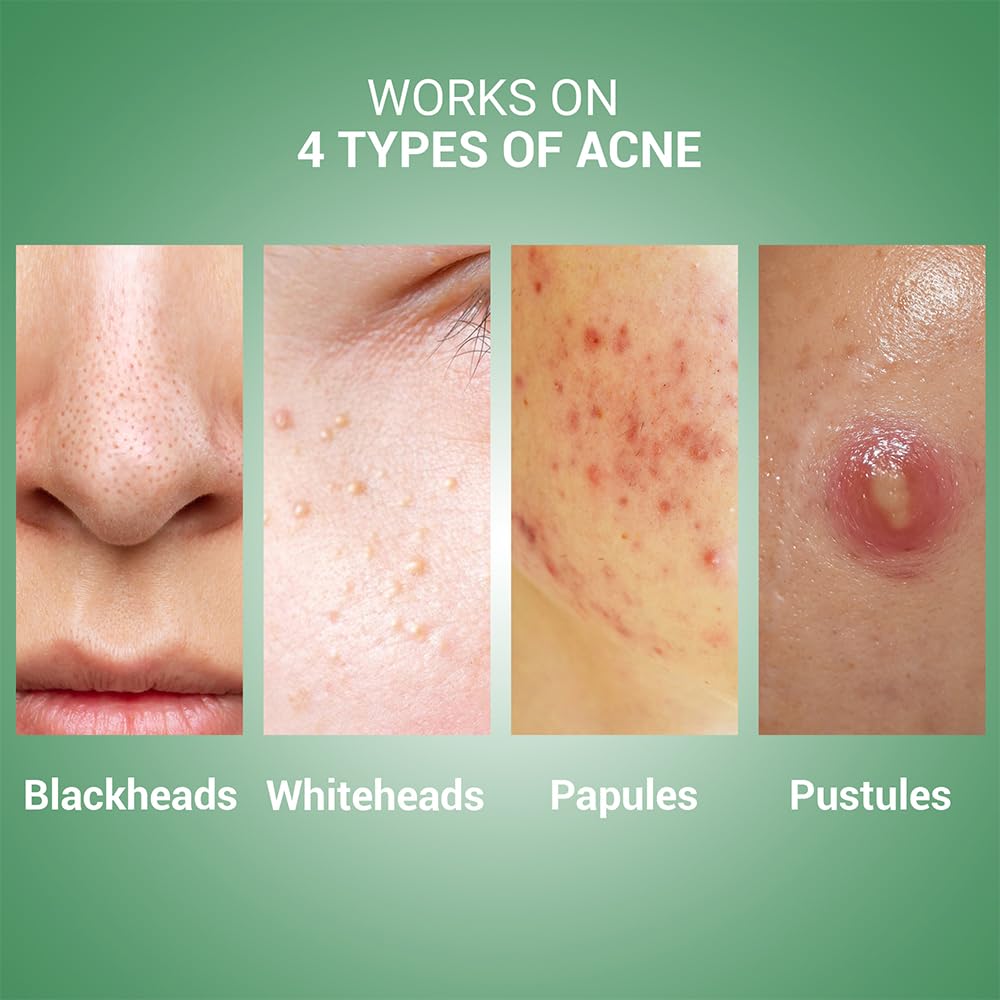 Sereko Skin Clearing Syrup | Sea Buckthorn,Manjishtha,Shatavri & Berberine + 12 Purifying Actives | Blood Purifier,Acne & Pimple Control | Enhances Skin Glow | Mixed Berry Flavour- 200 ML Pack of 1