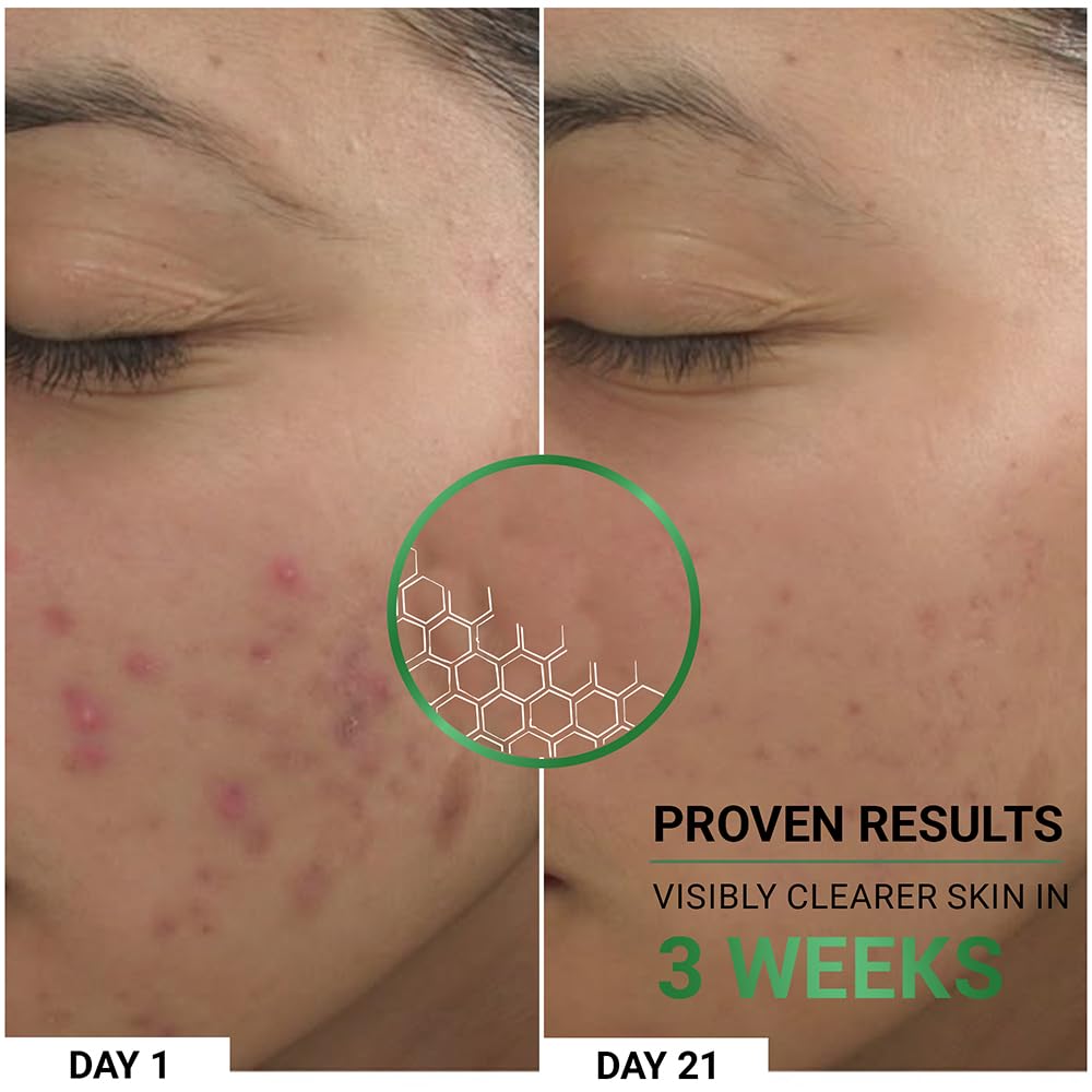 Sereko Clear Corrective Serum with 2% Encapsulated Salicylic Acid BHA & 3% Azelaic Acid | Active Acne | Reducing Sebum Production | Pigmentation & Dark Spots for Oily | Acne-Prone Skin 30ml - Pack 1