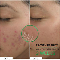 Sereko Clear Corrective Serum with 2% Encapsulated Salicylic Acid BHA & 3% Azelaic Acid | Active Acne | Reducing Sebum Production | Pigmentation & Dark Spots for Oily | Acne-Prone Skin 30ml - Pack 1