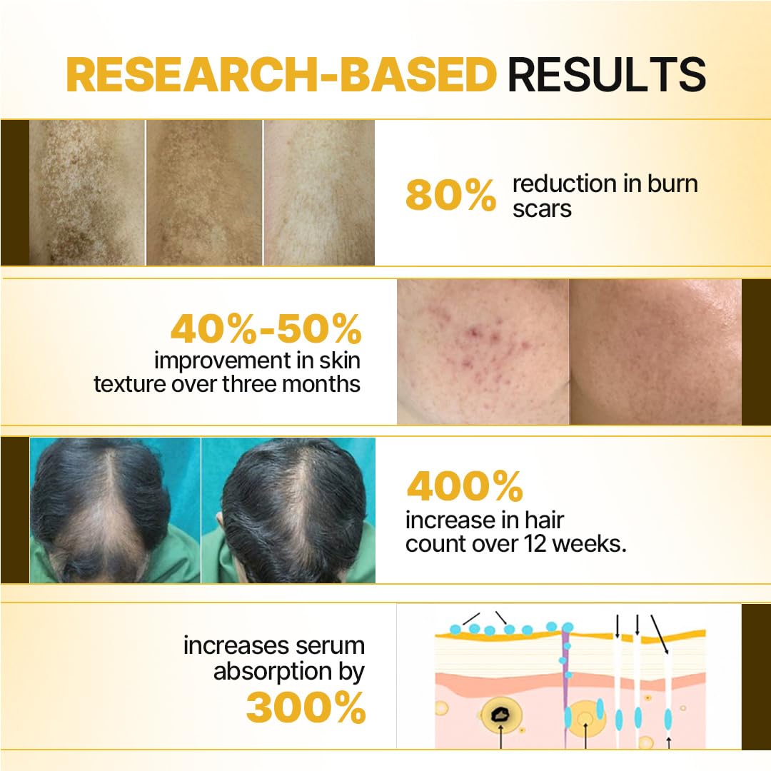 Sotrue Professional Derma Roller For Hair Growth 1 mm with 192 Stainless Steel Needles | Repairs Damaged Hair, Activates Hair Follicles | For Hair Fall & Hair Thickening | Reduces Acne Scars | Safe & Effective To Use