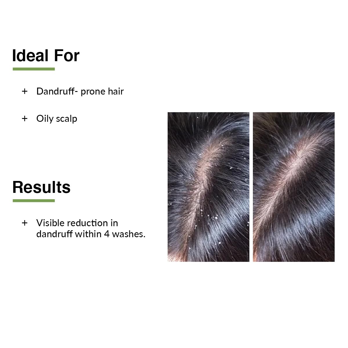 Fixderma Kairfoll Anti Dandruff Shampoo for Oily Sensitive Scalp Prone to Dandruff & Folliculitis | Anti Dandruff Shampoo for Women & Men | Salicylic Acid for Hair Fall | Sulphate Free Shampoo - 100ml