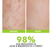 Conscious Chemist® 2% Salicylic Acid Cream | 50g | Acne Spot Corrector | Moisturizer for Oily Acne Prone Skin, Face Cream for Men & Women, Overnight Acne & Oil Control, Itchiness & Redness, Non greasy Gel Cream - Flashfix