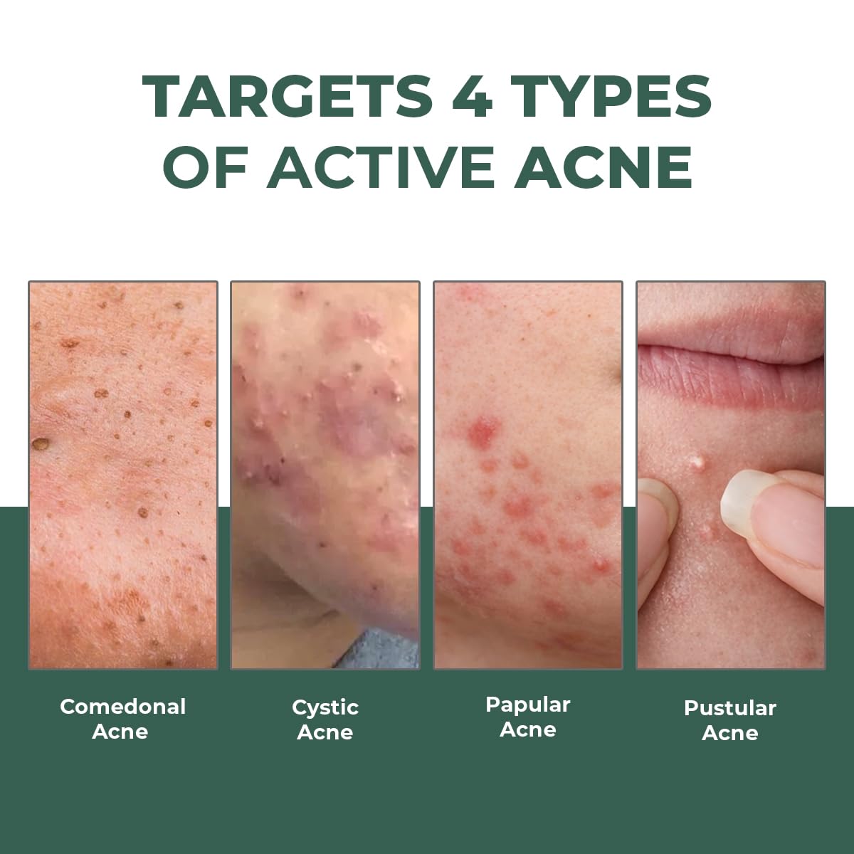 Conscious Chemist® Rapid Relief Acne Spot Corrector Gel | 15g | Triple-Action Treatment with 2% Salicylic Acid & Azelaic Acid | Clears Pimples, Reduces Redness & Fades Dark Spots | For Men & Women