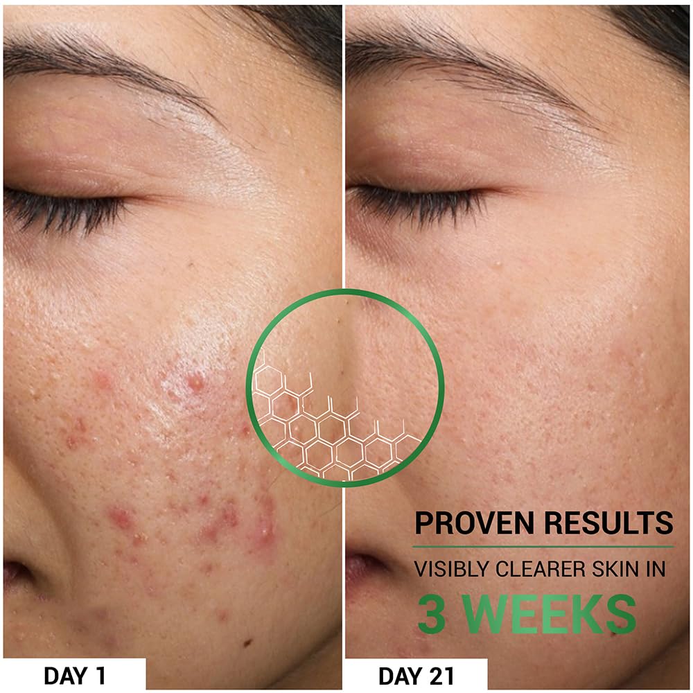 Sereko Oil Clear Face Moisturizer with NMF for Oily & Acne-Prone Skin | Controls Oil, Dehydrated Skin, Soothes Redness & Improves Texture | Lightweight, Non-Greasy Formula | Acne Cream 50ml