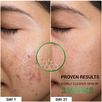 Sereko Oil Clear Face Moisturizer with NMF for Oily & Acne-Prone Skin | Controls Oil, Dehydrated Skin, Soothes Redness & Improves Texture | Lightweight, Non-Greasy Formula | Acne Cream 50ml