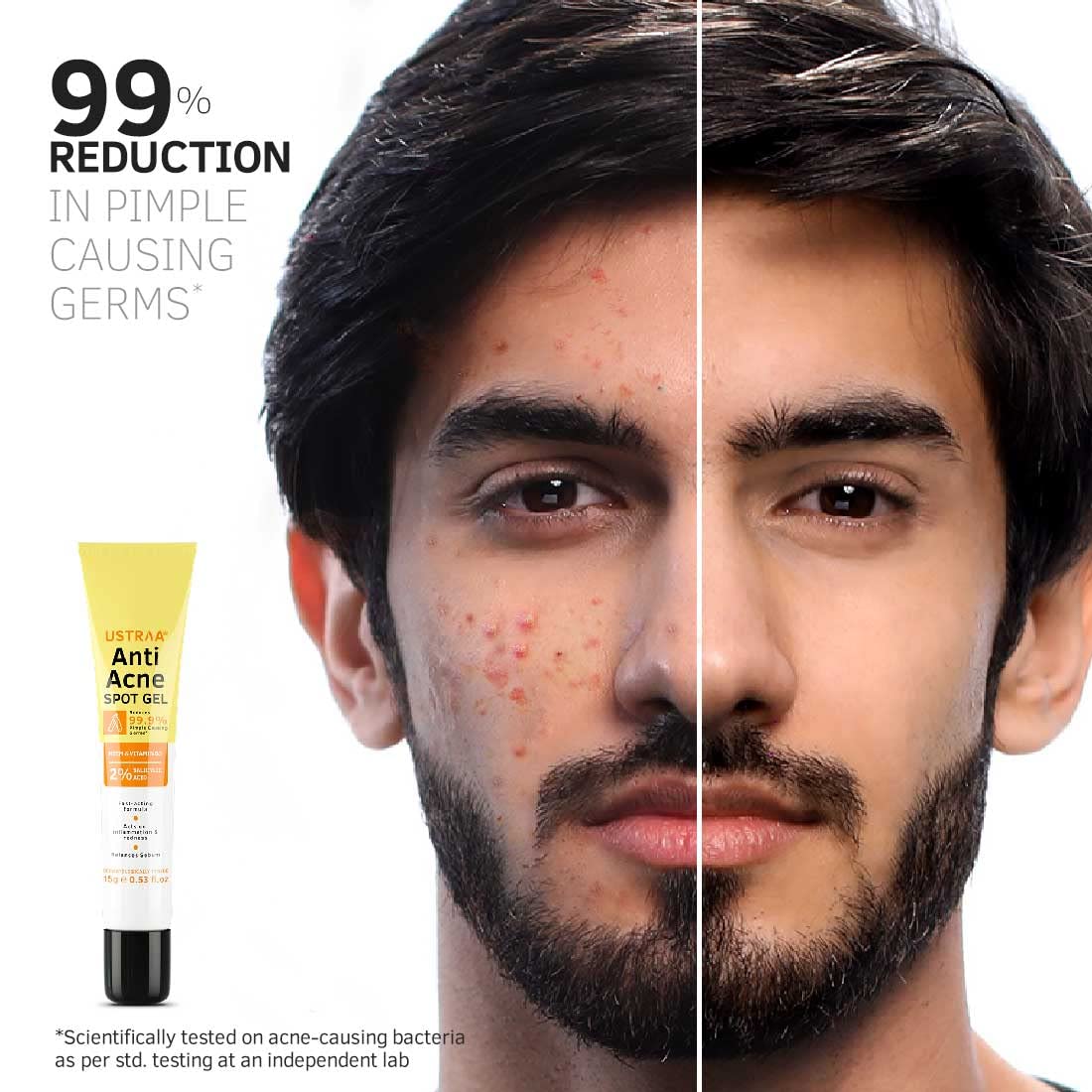 Ustraa Anti-Acne Spot Gel - 15 ml | Reduces 99.9% Pimple-causing Germs | 2% Salicylic Acid - Removes Dead Skin & Clears Pores | Dermatologically Tested | Oil-free | Reduces Acne & Redness