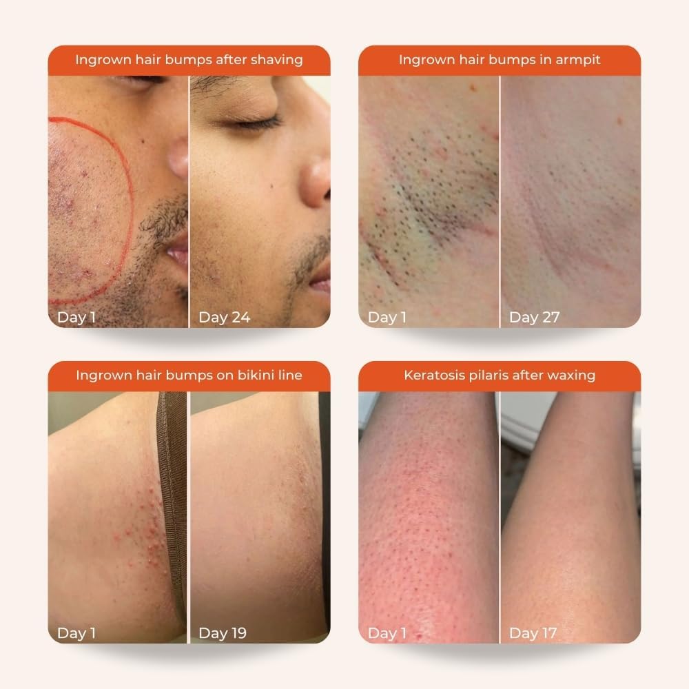 Skinvest Bye Bye Bumps Exfoliating Mist 50ml | Treats Ingrown hair, Strawberry skin, Razor bumps post waxing/shaving, Acne, Itchiness, Uneven skin texture | All Skin Types - for Men & Women | Dermatologist Tested