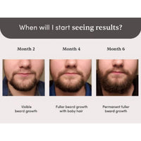 Man Matters Beardmax Growth Serum 30ml | 5% Minoxidil | Activates Beard Follicles | Solves Uneven & Patchy Beard | Alcohol Free