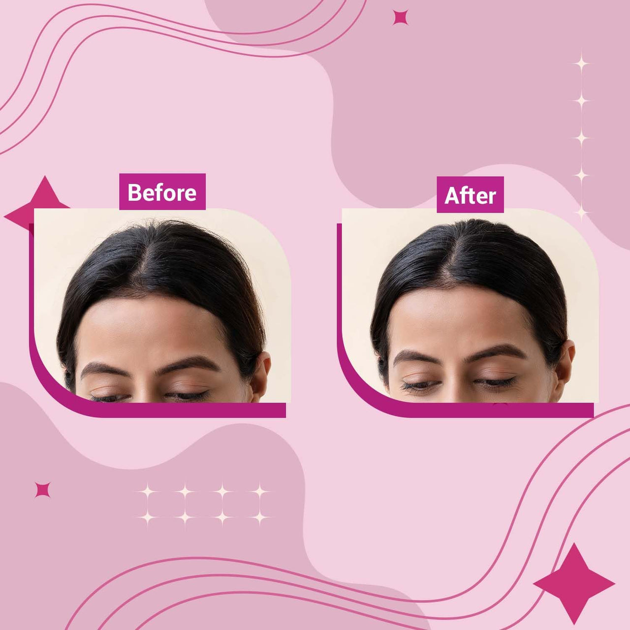 Beardhood Acne Pimple Patch | 72 Hydrocolloid Waterproof Patche and Sotrue Finish Line Hair Finishing Stick For Women 12ml