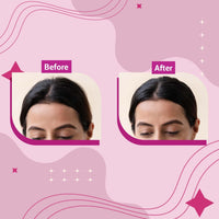 Beardhood Acne Pimple Patch | 72 Hydrocolloid Waterproof Patche and Sotrue Finish Line Hair Finishing Stick For Women 12ml