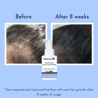 WishCare Hair Growth Serum Concentrate - 3% Redensyl, 4% Anagain, 2% Baicapil, Caffeine, Biotin & Rice Water - Advanced Hair Growth Serum for Hair Fall Control & Hair Growth 30ml