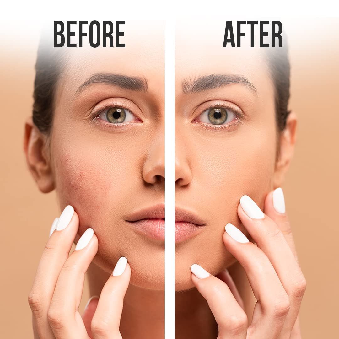 FURR Anti Acne Face Wash 2% Salicylic Acid with Green Tea | Controls Active Acne | Reduces Blemishes | Exfoliates Dead Skin Cells | Face Wash For Men & Women | 100ml