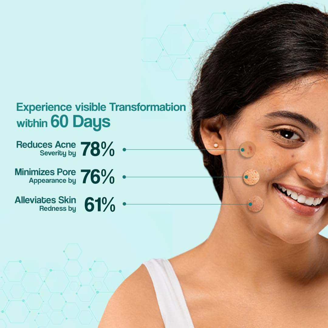 VENUSIA Dr. Reddy's  Acne Control Moisturizer I For Oily & Acne Prone Skin I Prevents Acne Breakouts|Oil Free, Non Sticky I 75G