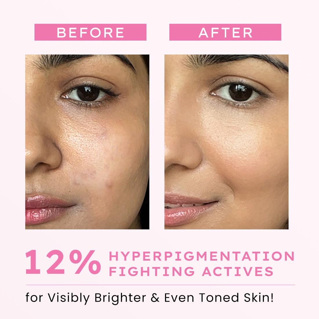 Hyphen Advanced De-Pigmentation Serum For Hyperpigmentation, Melasma, Dark Spots & Scars With 2% Kojic Acid | Visibly Brightens & Even Tones Skin | Serum For Women & Men - 30ml