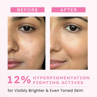 Hyphen Advanced De-Pigmentation Serum For Hyperpigmentation, Melasma, Dark Spots & Scars With 2% Kojic Acid | Visibly Brightens & Even Tones Skin | Serum For Women & Men - 30ml