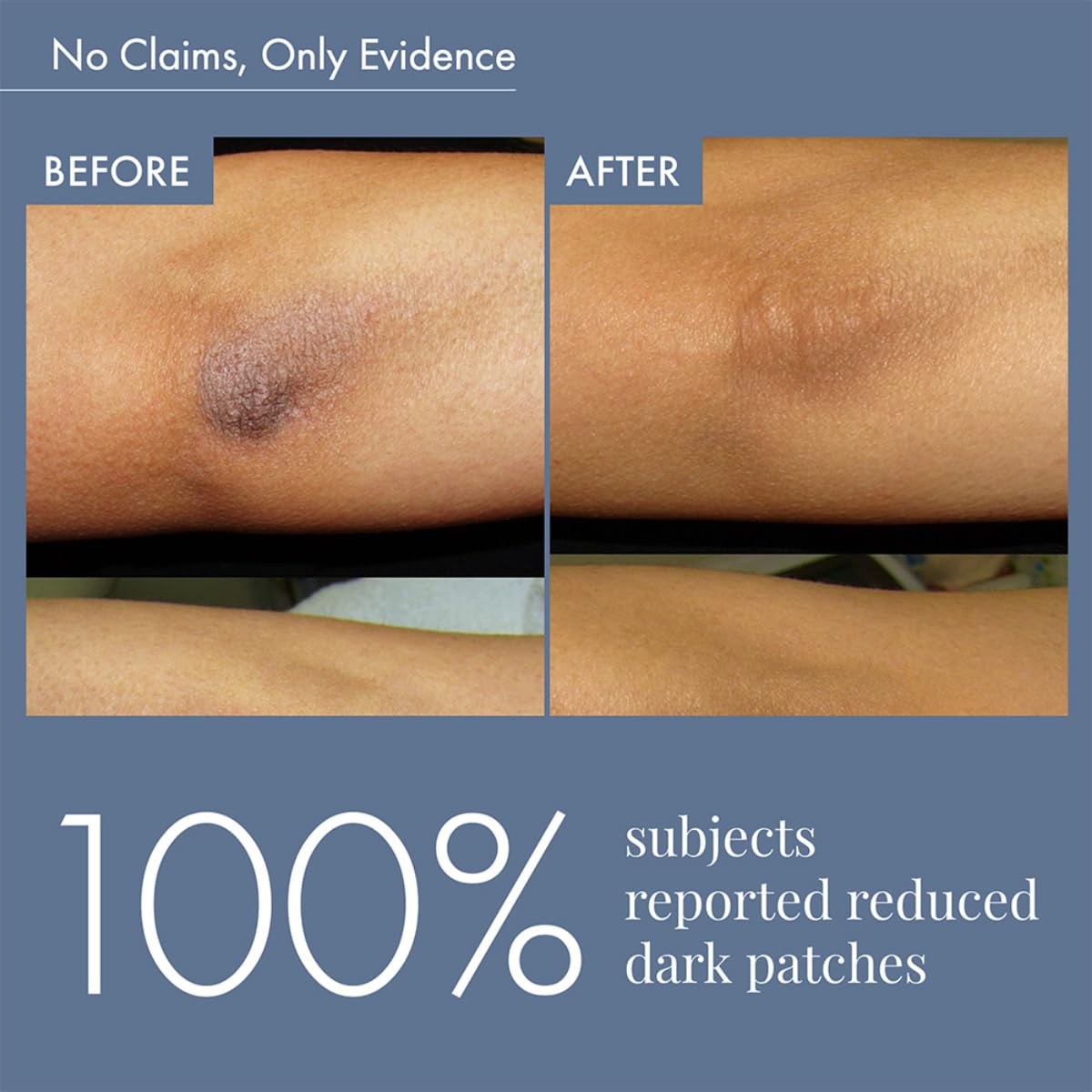 ThriveCo Dark Patches Corrector Cream| Dark Patches Removal | With Retinal &Niacinamide for Dark Neck, Underarms, Inner Thighs, Knuckles, Elbows & Knees. Men & Women | 100ml