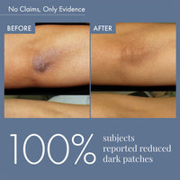 ThriveCo Dark Patches Corrector Cream| Dark Patches Removal | With Retinal &Niacinamide for Dark Neck, Underarms, Inner Thighs, Knuckles, Elbows & Knees. Men & Women | 100ml