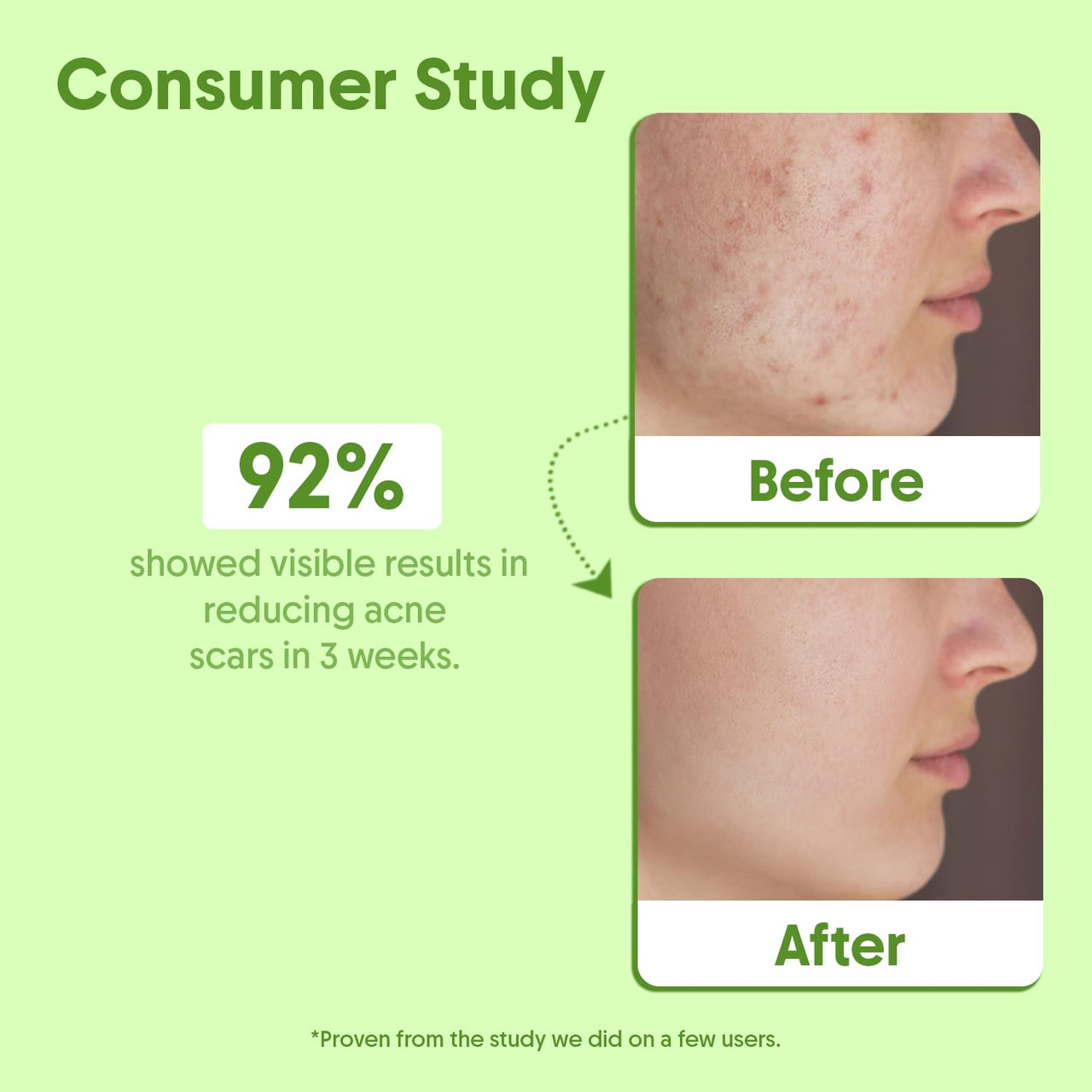 Aravi Organic Tea Tree Essential Oil For Skin, Hair, Face, Acne Care, Dandruff - 100% Pure, Natural and Undiluted - 15 ml