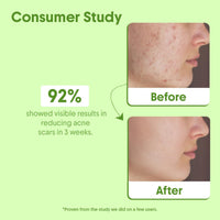 Aravi Organic Tea Tree Essential Oil For Skin, Hair, Face, Acne Care, Dandruff - 100% Pure, Natural and Undiluted - 15 ml