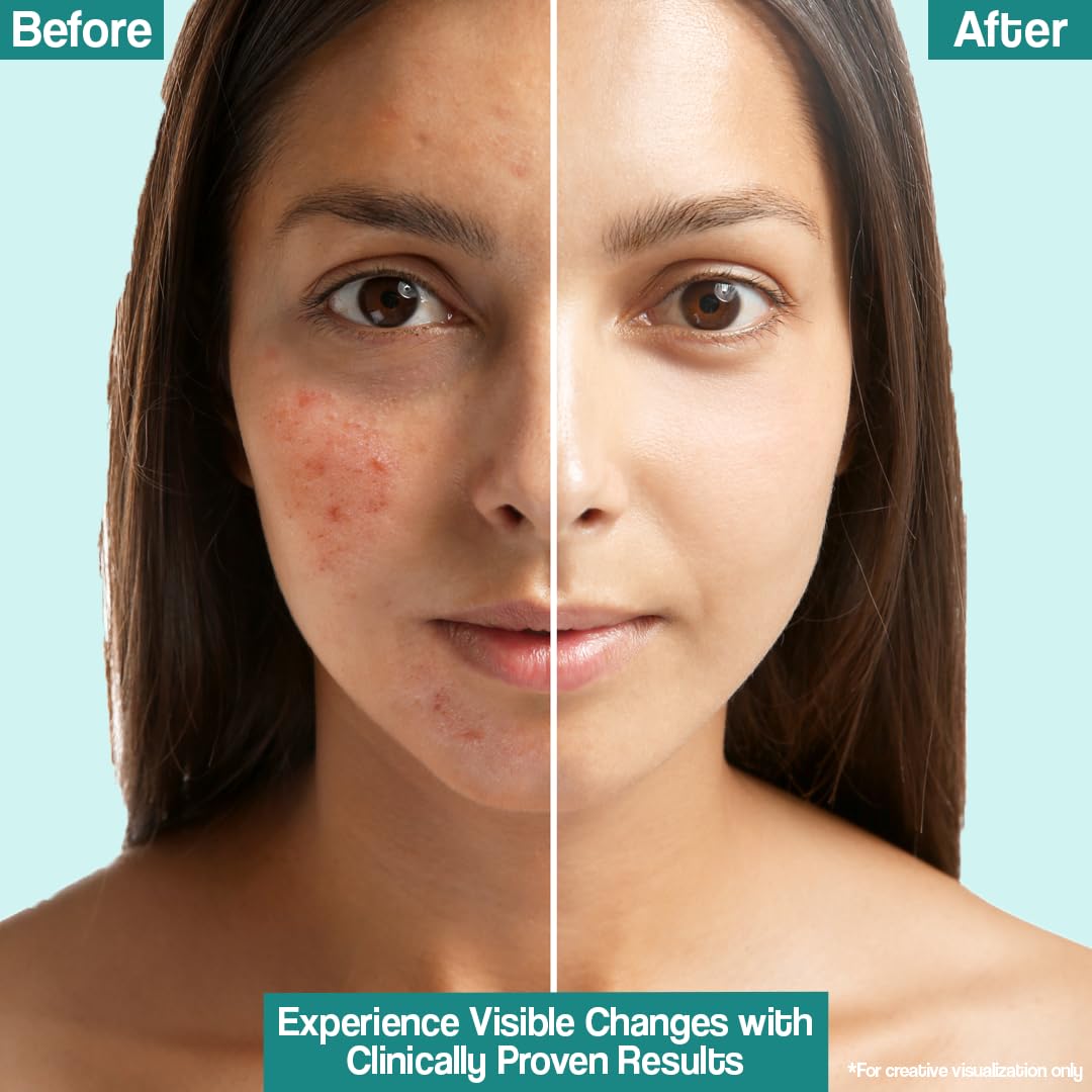 VENUSIA Dr. Reddy's  Acne Control Moisturizer I For Oily & Acne Prone Skin I Prevents Acne Breakouts|Oil Free, Non Sticky I 75G