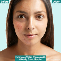 VENUSIA Dr. Reddy's  Acne Control Moisturizer I For Oily & Acne Prone Skin I Prevents Acne Breakouts|Oil Free, Non Sticky I 75G