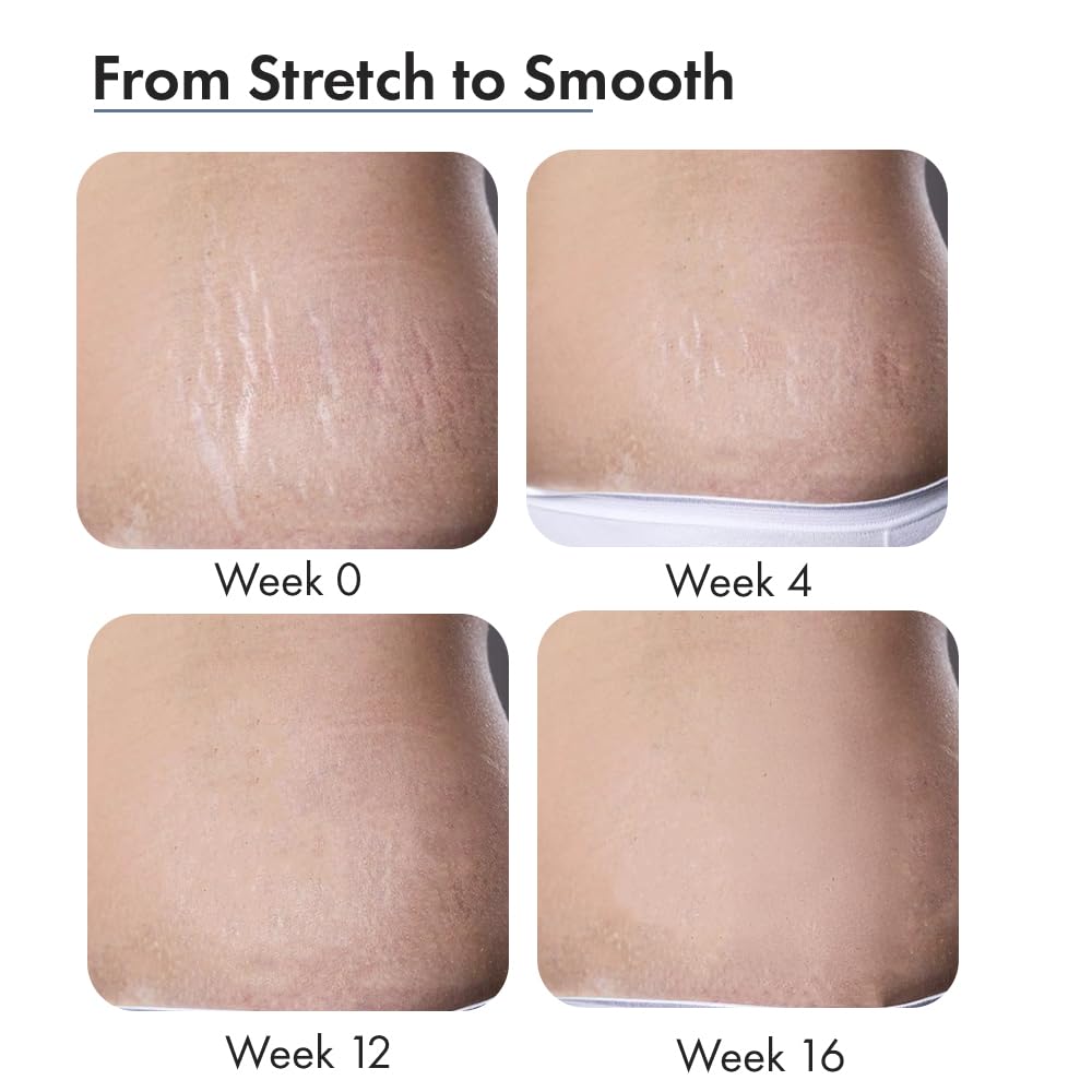 ThriveCo Stretch Marks Expert Serum Cream | For New (red) & Old (white) Stretch Marks Removal & Skin Hydration | Powered by Striover™, Rosehip Oil & Squalane | For Men & Women | 30ml