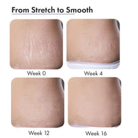 ThriveCo Stretch Marks Expert Serum Cream | For New (red) & Old (white) Stretch Marks Removal & Skin Hydration | Powered by Striover™, Rosehip Oil & Squalane | For Men & Women | 30ml