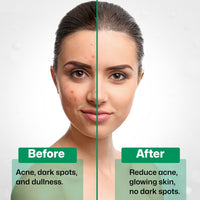 KAZIMA 2% Salicylic Acid Face Serum for Acne, Blackheads & Open Pores | Reduces Excess Oil & Exfoliates Skin | Salicylic Acid Serum for Acne-prone & Oily Skin | For Women & Men | 30 ml