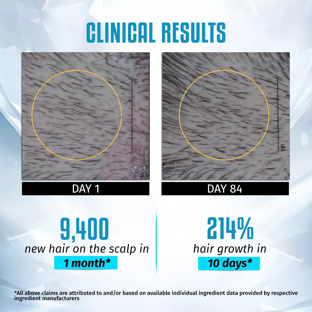 Sesa Ayuscience 3% Redensyl, 4% Anagain, 2% Kerascalp Hair Growth Serum With Rosemary, Bhringraj, Neem For Hair Growth Strengthens Roots Controls Hair Fall - 30ml