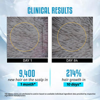 Sesa Ayuscience 3% Redensyl, 4% Anagain, 2% Kerascalp Hair Growth Serum With Rosemary, Bhringraj, Neem For Hair Growth Strengthens Roots Controls Hair Fall - 30ml