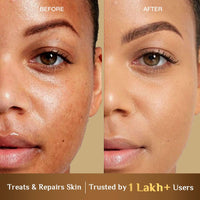 Richfeel Anti Acne Calendula Face Wash | Power of Soothing Calendula Extracts | For Skin prone to Acne & Blemishes | Physician Formulated | Helps Calm & Replenish Skin | 100 g (Pack of 2)